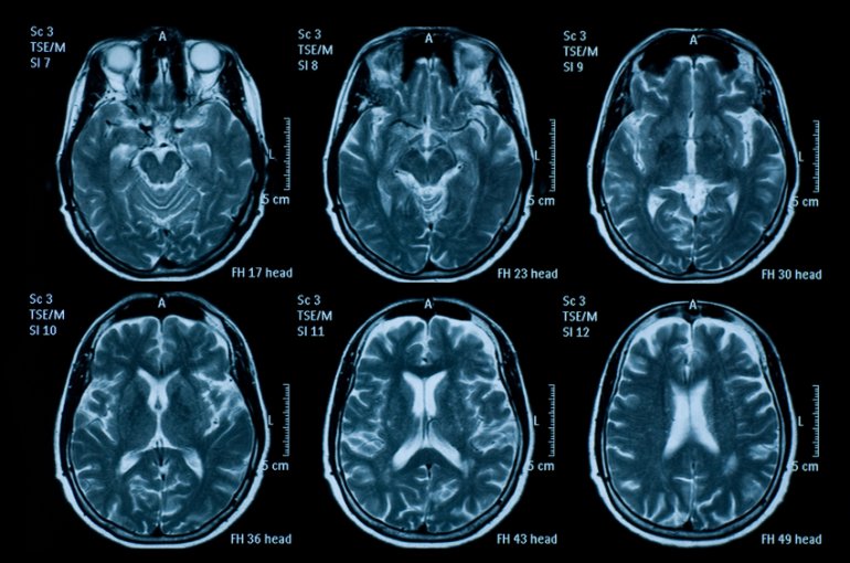 Transforming Research And Clinical Knowledge In TBI | TRACK-TBI